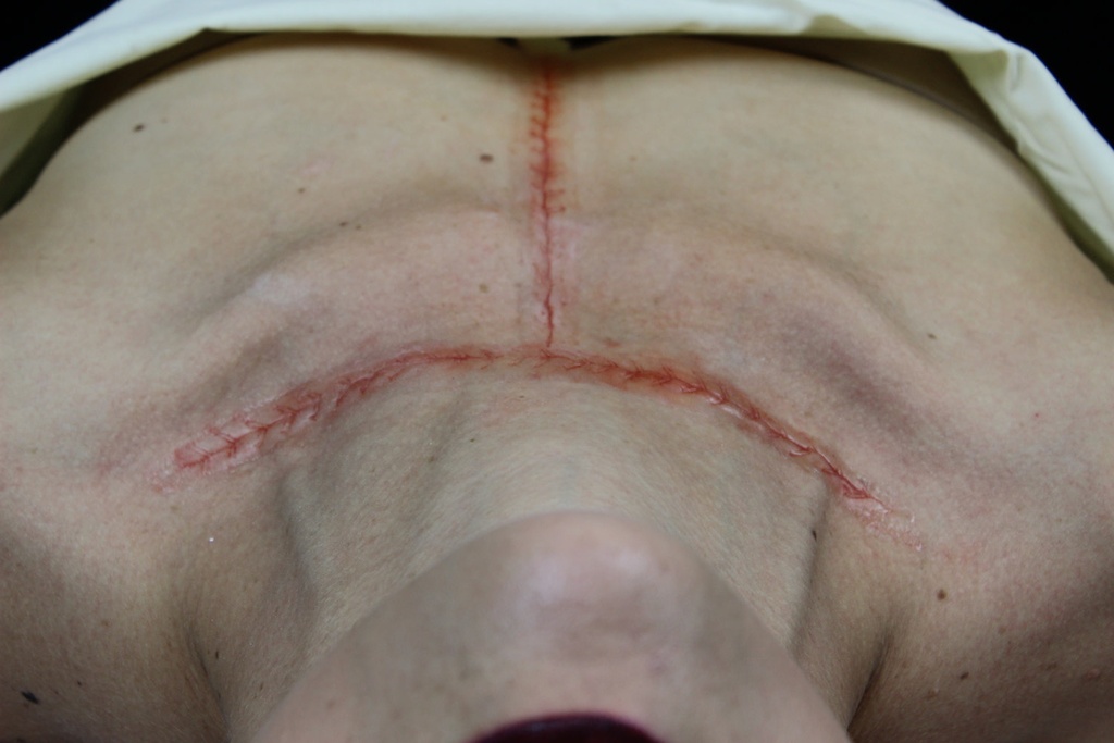 FX Makeup- Final Closure