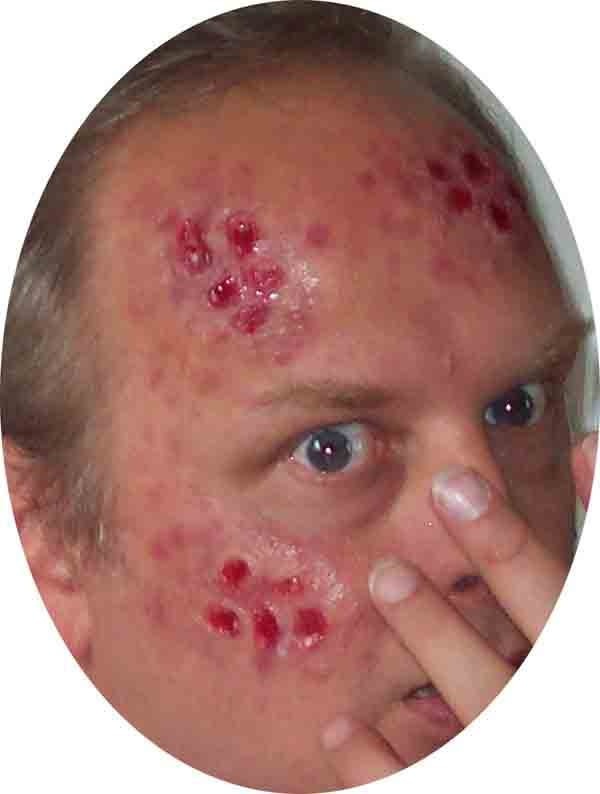 FX Makeup-Lesions Aired